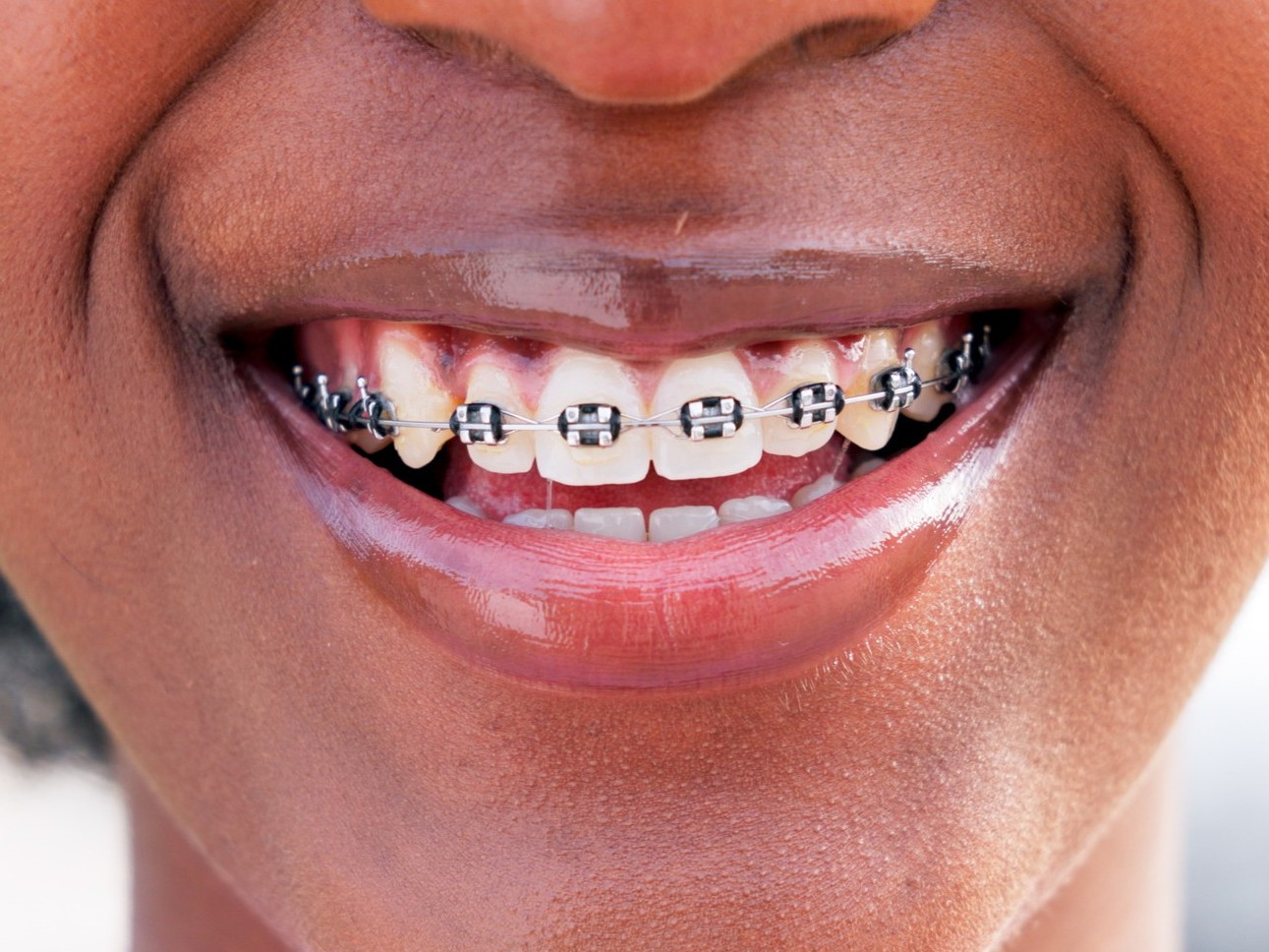 happy-smile-and-mouth-of-woman-with-braces-in-cit-2024-12-11-17-55-01-utc (1)