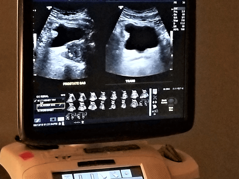 kidney-ultrasound-2025-02-21-06-33-21-utc