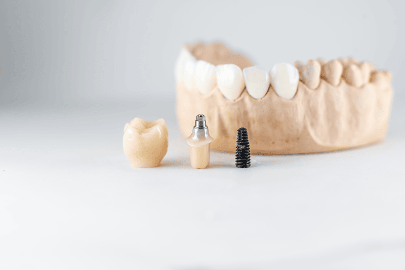 model-of-artificial-jaw-and-dental-implant-2023-11-27-05-19-37-utc