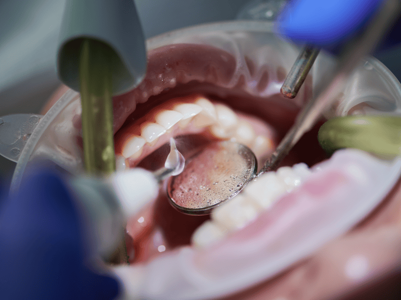 orthodontist-doing-professional-teeth-cleaning-in-2025-01-16-22-14-31-utc